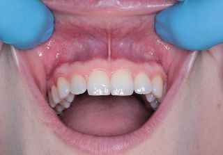 Soñar con los dientes ¿ Qué significa ?